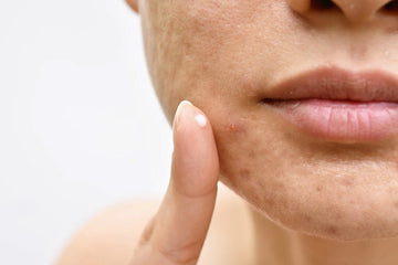 The Ultimate Acne Guide: Types of Acne, Causes of Acne & Getting on top of Acne Control