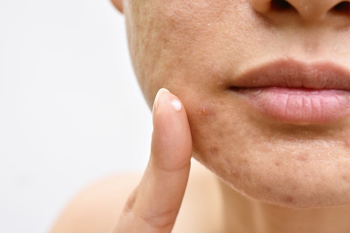 The Ultimate Acne Guide: Types of Acne, Causes of Acne & Getting on top of Acne Control