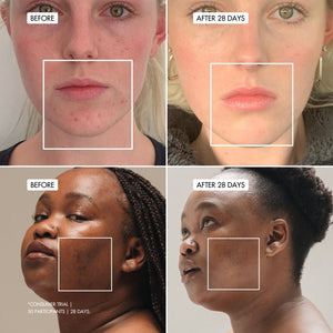 GINGER LILY Oil Control Face Gel-Cream User trials before and after